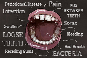 Symptoms of Gum Disease Illustration