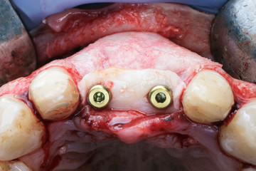 macro shooting with complex Dental implantation, membrane and tissue to build up the gums