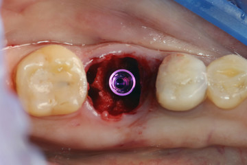 Obraz premium beautiful macro photography Dental abutment after successful implantation