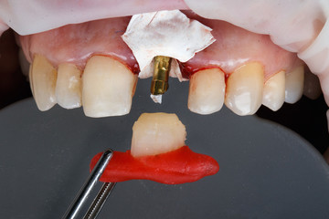 Dental crowns transfer to the front cutter