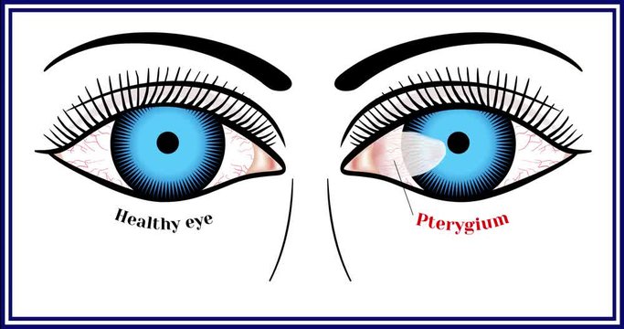 Pterygium. Spreading of the conjunctiva of the eye on the cornea. Animation.