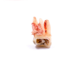 single extracted tooth with caries decay isolated on white background