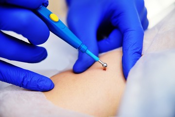 Medical surgical treatment removal of a mole on the hand of a young woman patient. Use of safe...