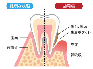 歯周病と健康な歯　断面図