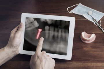 Auf einer Röntgenaufnahme Sitz des Implantat besprechen.