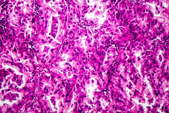 Histopathology Of Lung Cancer