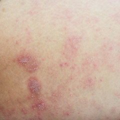 ill allergic rash dermatitis eczema skin texture , Allergic skin lesions