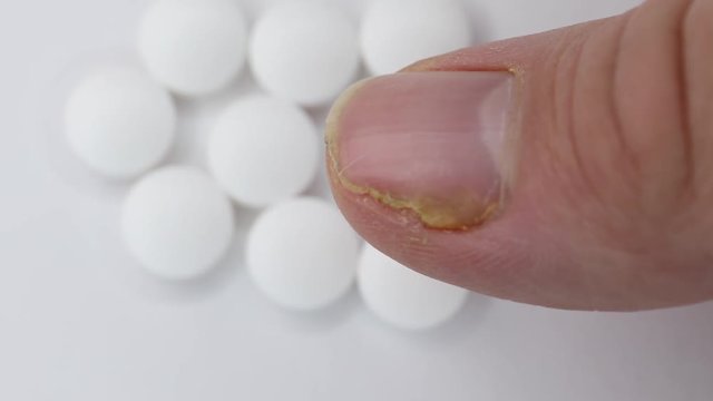 Close up of nail fungus infection on the thumb finger. Fungal infection on nails hand, finger with onychomycosis, damage on human hand