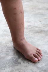 Fototapeta na wymiar Itchy dermatitis atopic baby foot. Close up Infected wound.Opened wound at left leg.