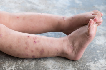 Itchy dermatitis atopic baby foot. Close up Infected wound.Opened wound at left leg.