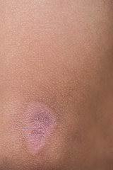 Human skin is scarred.