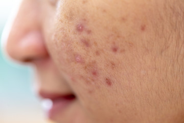 Fototapeta premium Backgrounds of lesions skin caused by acne on the face in the clinic.