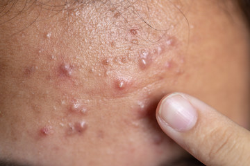 Backgrounds of lesions skin caused  by acne on the face in the clinic.