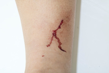Blood on leg skin, leg wound accident.