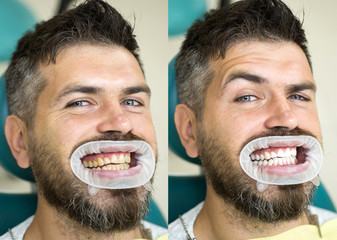 White teeth - before and after concept. Close-up detail of man teeth before and after whitening....