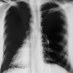 lung radiography, or x-ray film lung examination