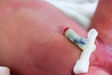 a clamped umbilical cord stump of a newborn baby