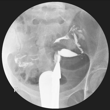 Hysterosalpingography (HSG) is a fluoroscopic X-ray study of a woman's uterus and fallopian tubes.