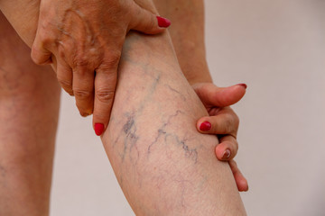 An elderly woman in white panties is touching her legs with cellulite and varicose veins on a light...