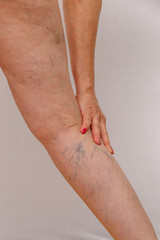 An elderly woman in white panties is touching her legs with cellulite and varicose veins on a light...