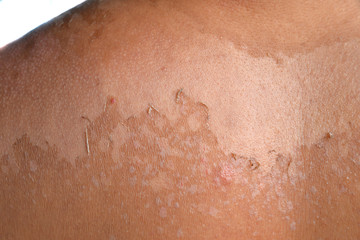 Fototapeta premium Small detail of a sunburned peeling