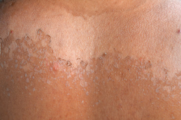 Fototapeta premium Small detail of a sunburned peeling