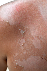 Fototapeta premium Small detail of a sunburned peeling