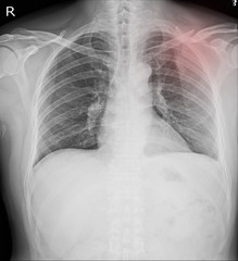 Chest x-ray Fractures left clavicle, anterior 2nd rib, posterior rib 4,5  and lateral aspect of left 6 th rib.