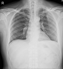 Chest x-ray Fractures left clavicle, anterior 2nd rib, posterior rib 4,5  and lateral aspect of left 6 th rib. - obrazy, fototapety, plakaty