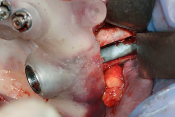 Dental implant set Sieg pattern, close-up shot