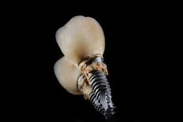 close-up photo of the extracted implant and Dental crowns on black glass