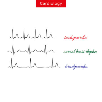 Tachycardia and bradicardia. Difference of heart pulsating, Fast and slow rhythm of heart. Normal heart rhythm.
