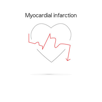 Schematic Electrocardiogram of miocardial infaction.