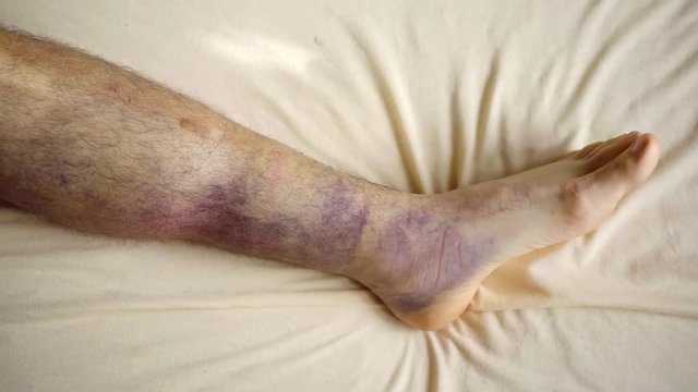 male patient of hospital is moving his foot, his leg is covered by large bruises after bone fracture