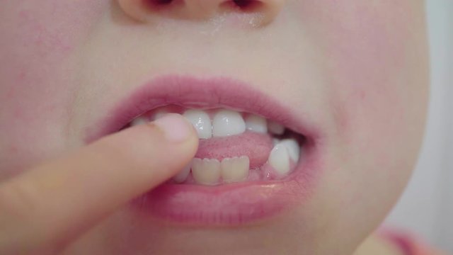 Child wobbles at a loose milk tooth