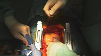 16 october 2018 NY USA Surgeons team operating heart operating live shot - Powered by Adobe