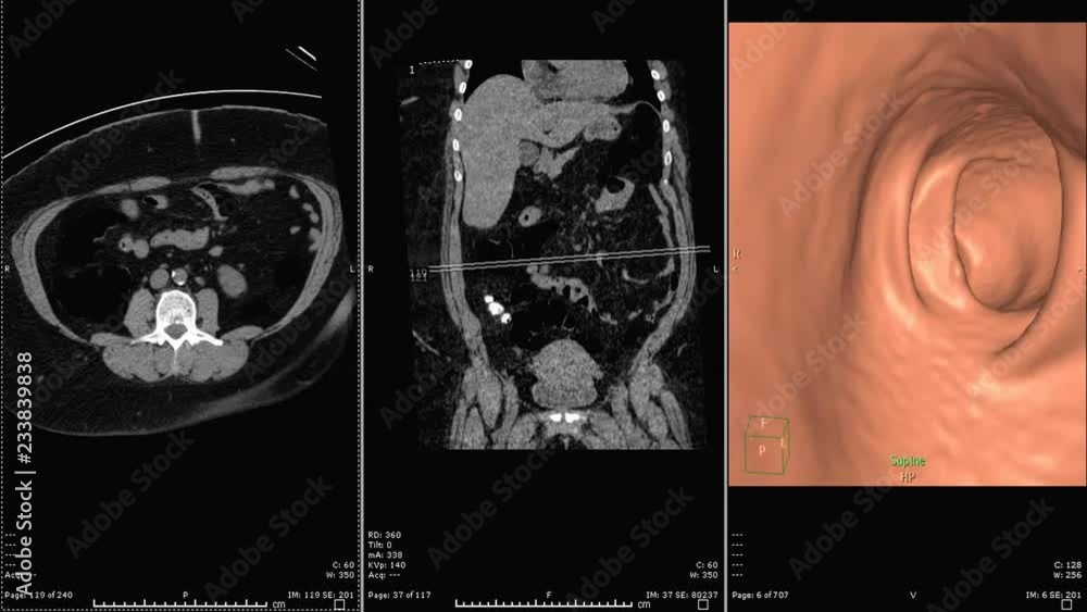 Aufkleber ct colonography or ct scan of colon axial view vs coronal view and 3d rendering image from ct scanne