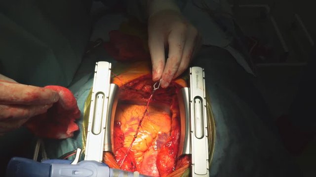 16 october 2018 NY USA Heart surgery. Open heart surgery suture greater saphenous vein coronary artery bypass surgery