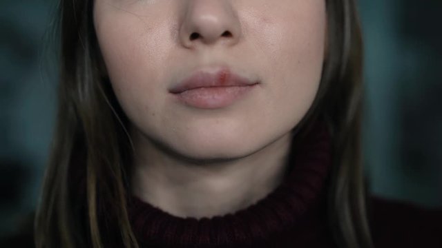 herpes on the lips, part of a woman's face with finger on lips with herpes, beauty concept
