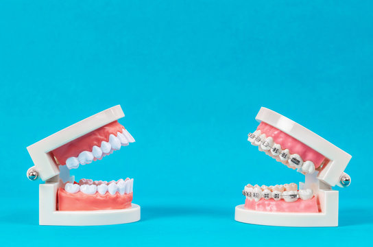 Compare tooth model and tooth model with metal wire dental braces.