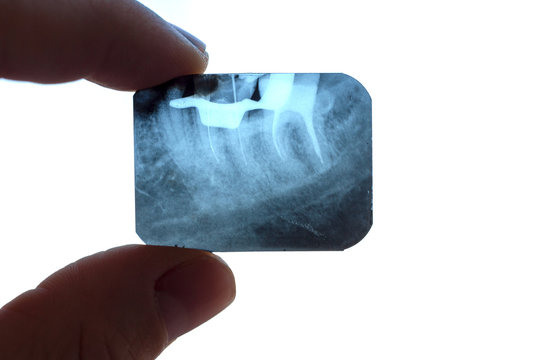 X-ray of the canals in the roots of the tooth with tools inside the doctor's fingers on a white background close-up. A doctor's hand correctly holds a tooth X-ray.