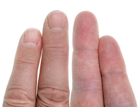 Older elderly people have dry and sore skin on fingers. Isolated