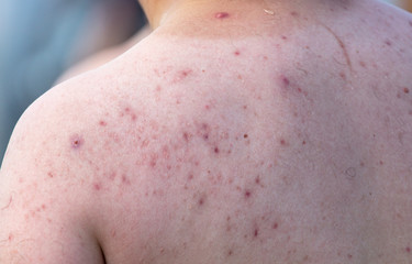 Pimples on the back of a man