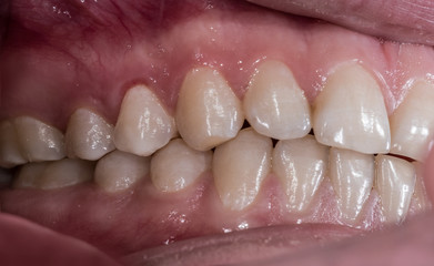 Healthy human teeth with normal occlusion from side view .