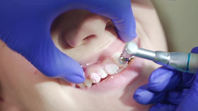 Professional removing teeth plaque in dental office. Close up teeth polishing