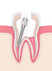 3d render of tooth with gutta percha, post and filling