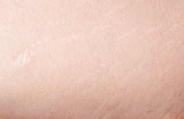 cellulite closeup on mature woman skin texture background