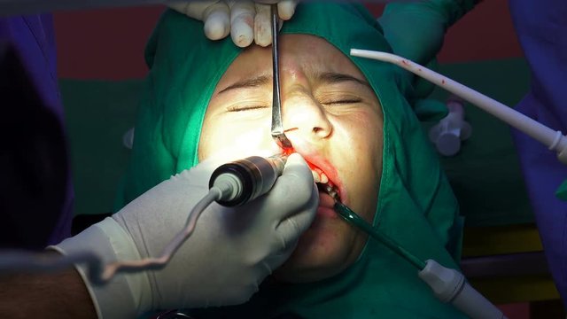 Oral dental surgery operation, tooth gum apicoectomy cyst removal
