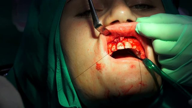 Dentist stitches women gum after tooth surgical operation of cyst removal