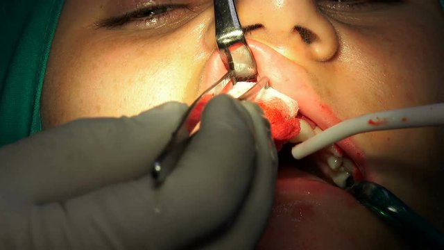 Oral surgery operation,cist apicoectomy, dark operation room